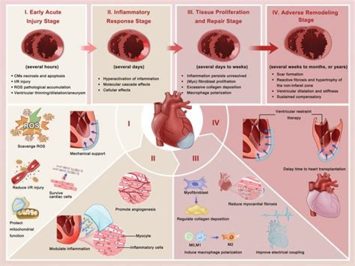 What is CABG in myocardial infarction?