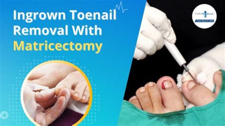What is chemical Matricectomy?