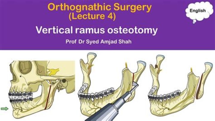 What is intraoral vertical ramus osteotomy?
