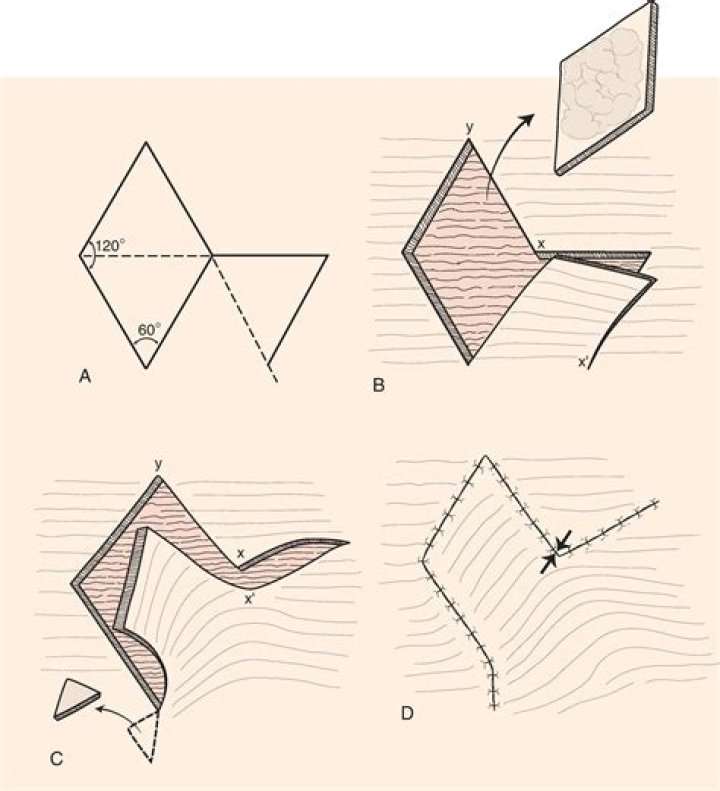 What is Limberg flap?