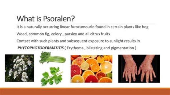 What is psoralen PUVA used for?
