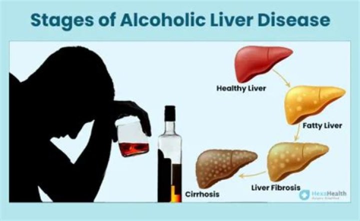 What is the first stage of alcoholic liver disease?