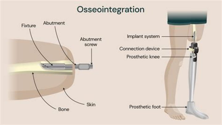 What is the meaning of osseointegration?