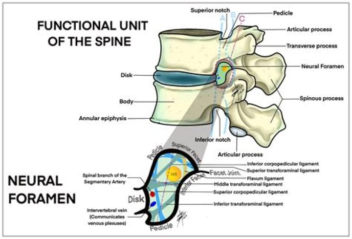 What is the treatment for neural Foraminal narrowing?