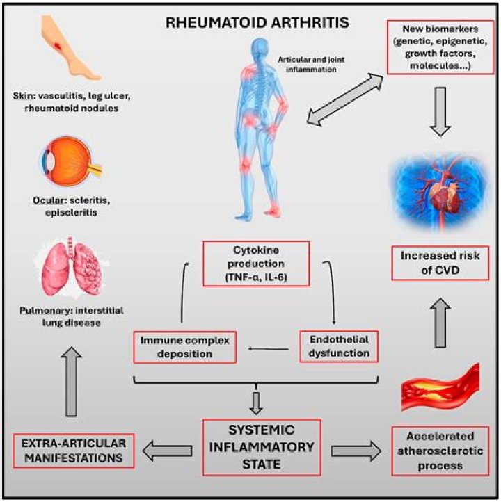 What mimics reactive arthritis?