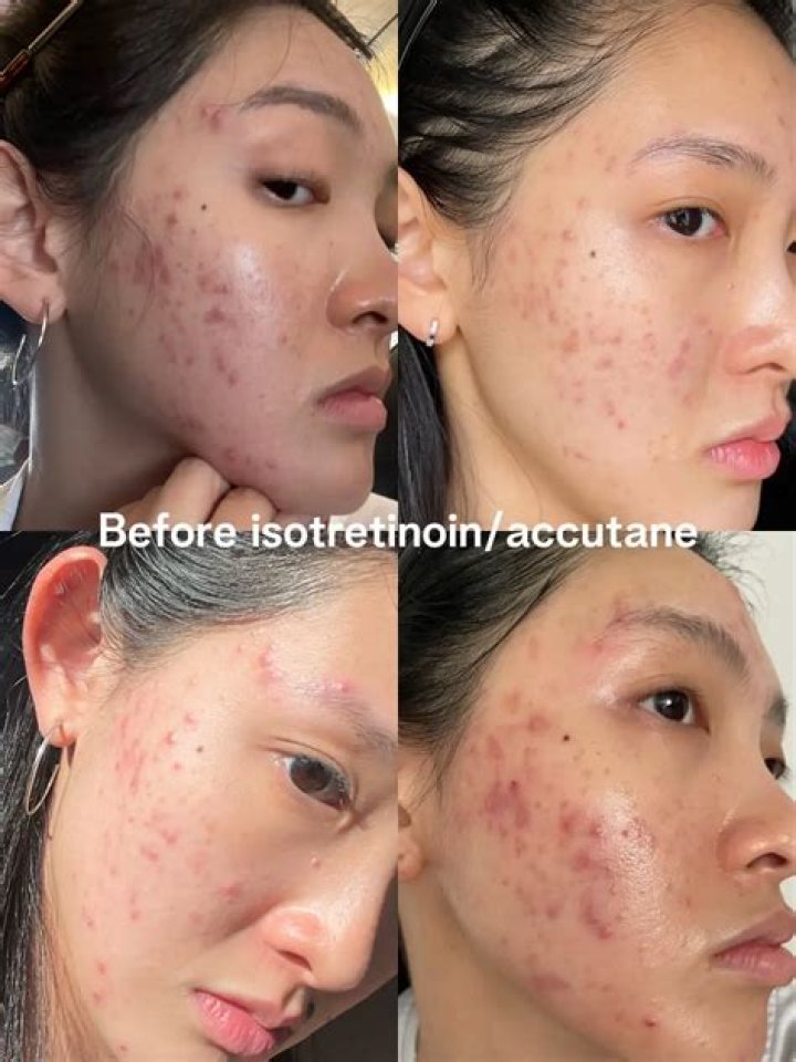 What should I know about isotretinoin before taking it?