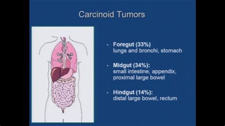 Where are neuroendocrine tumors located?
