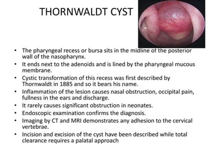 Where is a Thornwaldt cyst located?