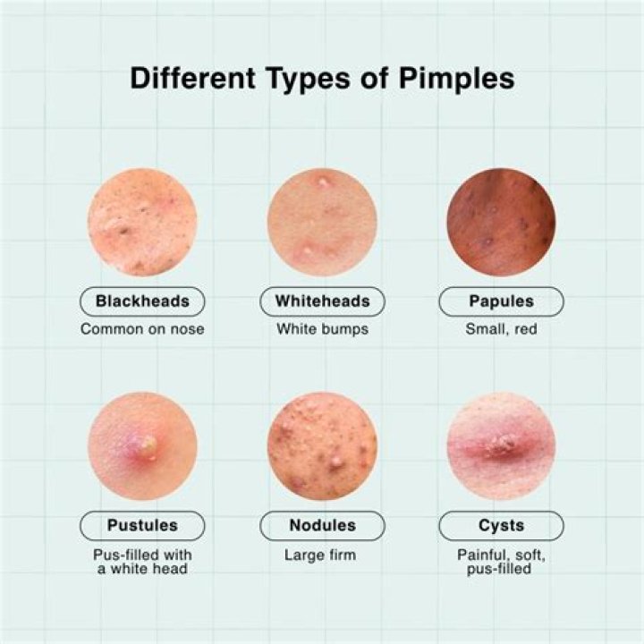 Why am I getting pimples in winter?