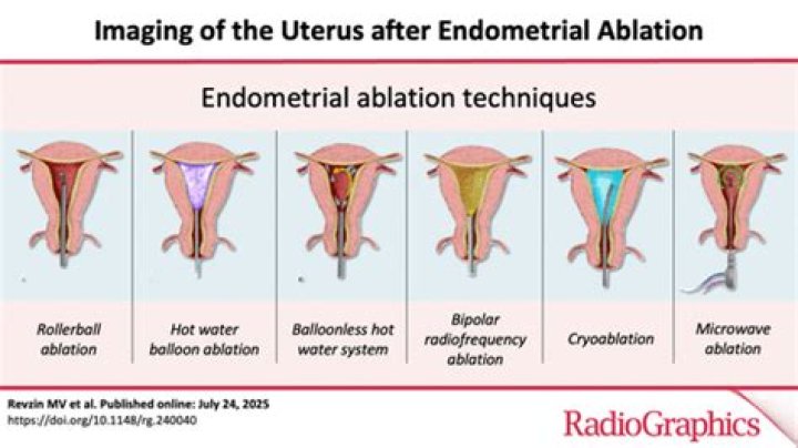 Why am I still bleeding after endometrial ablation?