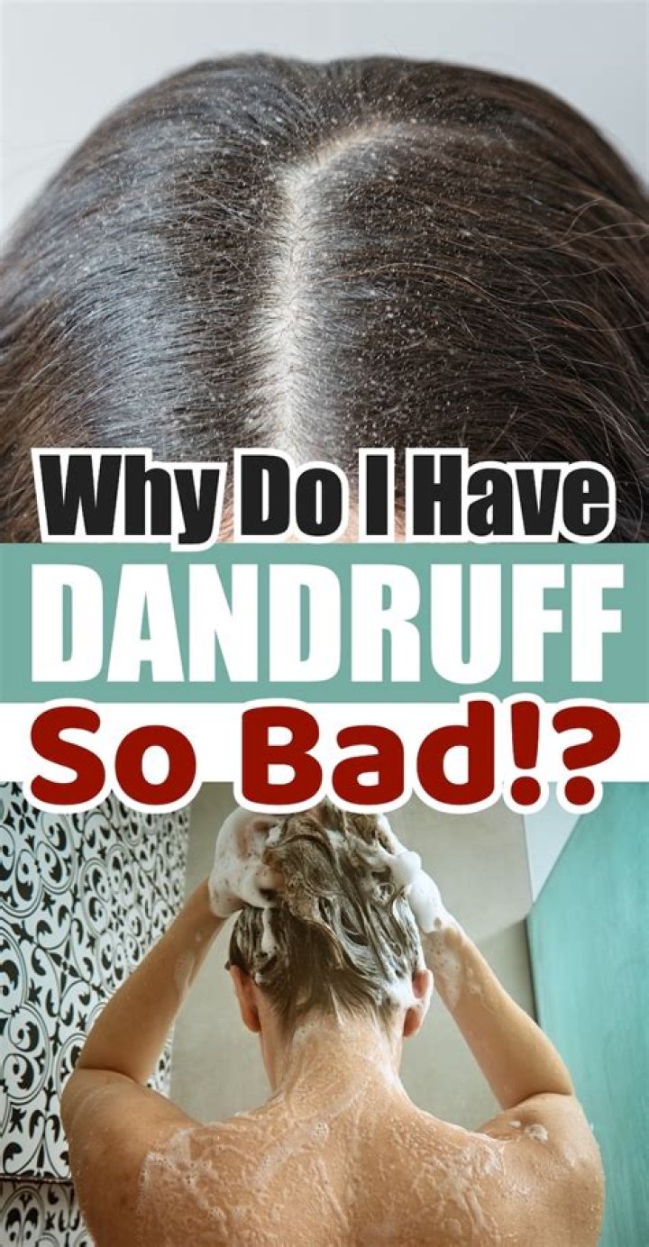 Why do I keep getting dandruff in my beard?