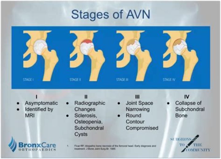Why do scaphoid fractures have AVN?