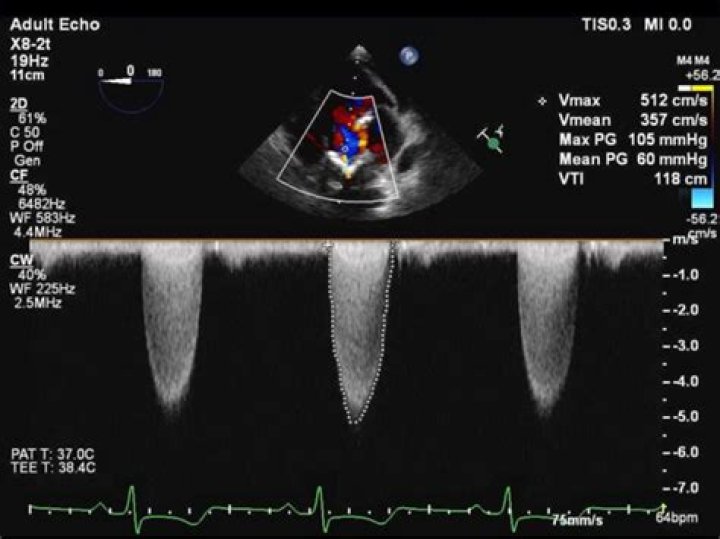 Why would you have a Doppler test?